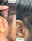 Derma Roller