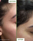 Derma Roller